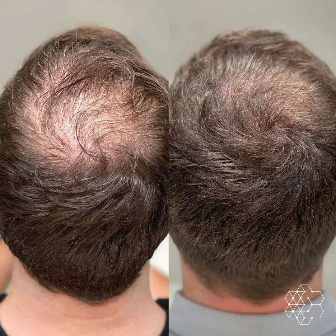 Microneedling with Derive Hair Restoration Serum