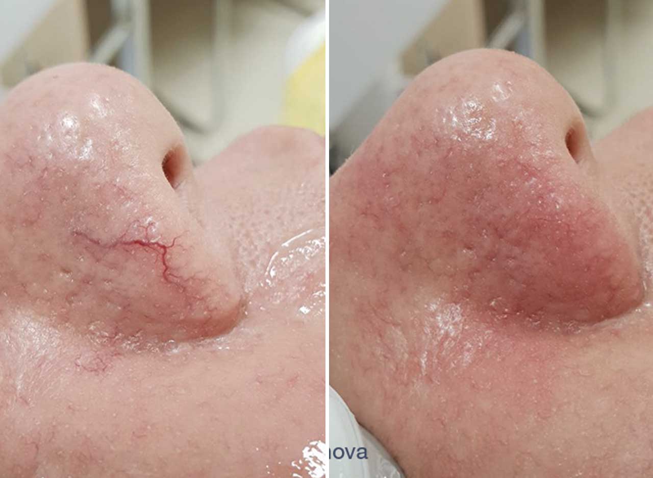 Vasculaze Treatment for Small Veins and Capillaries