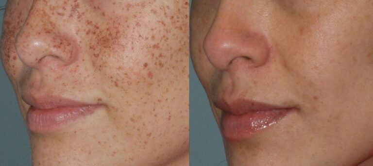 Vasculaze Treatment for Small Veins and Capillaries