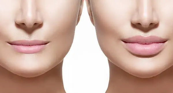 Filler (Juvederm, Restylane, and Revance RHA Products)