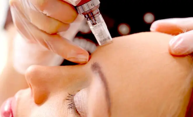 Microneedling (available with or without PRP)